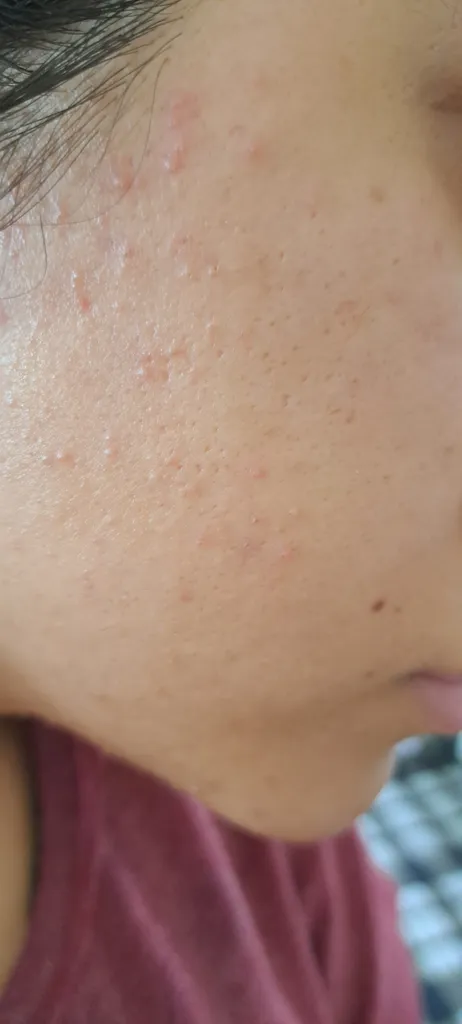 سرم ضد جوش رازو آکنی مدل سالیسیلیک اسید و ویتامین c حجم 70 میلی لیتر