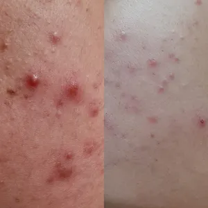 تجریه خرید ژل کرم ضد جوش سینره حجم 30 میلی لیتر