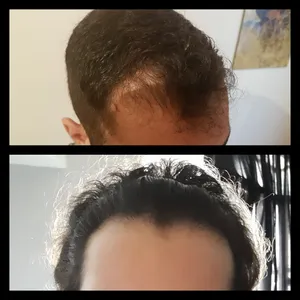 تجریه خرید تونیک مو لاناریا مدل Anti Hair Loss حجم 120 میلی لیتر بسته 2 عددی