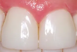 تجریه خرید ژل سفید کننده دندان فاردنتو مدل TSR وزن 20 گرم مجموعه دو عددی