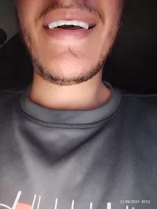 تجریه خرید لمینت متحرک دندان اسنپ اسمایل کد 110