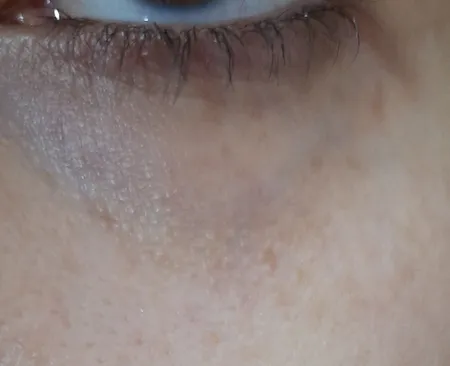 کرم دور چشم رنگی پرودرما سری Eyevest مدل Anti Wrinkle Spf 30 حجم ۲۰ میلی لیتر