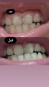 تجریه خرید پودر سفید کننده دندان وی وان مدل Eucalyptus وزن 50 گرم