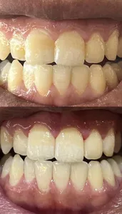 تجریه خرید سفید کننده دندان اسمایل کیت مدل V34 حجم 30 میلی لیتر