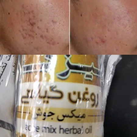 روغن ضد جوش تیزگل مدل mix حجم 50 میلی لیتر