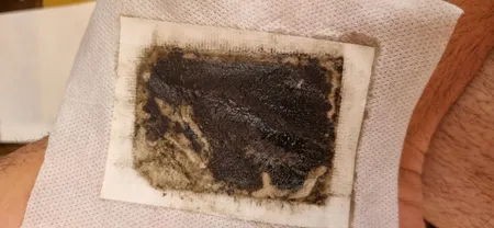 پد دفع سموم بدن کینوکی مدل mp-913 بسته 10 عددی