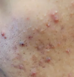 تجریه خرید ژل ضد جوش پرایم مدل Acnex مناسب پوست چرب حجم 30 میلی لیتر117437