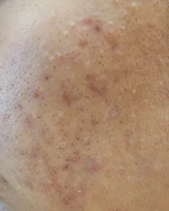 تجریه خرید ژل ضد جوش پرایم مدل Acnex مناسب پوست چرب حجم 30 میلی لیتر117437