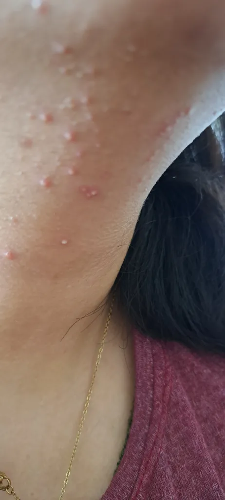 سرم ضد جوش رازو آکنی مدل سالیسیلیک اسید و ویتامین c حجم 70 میلی لیتر