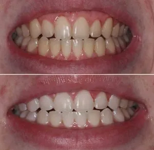 تجریه خرید سفید کننده دندان اسمایل کیت مدل V34 حجم 30 میلی لیتر