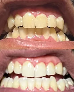 تجریه خرید سفید کننده دندان اسمایل کیت مدل V34 حجم 30 میلی لیتر