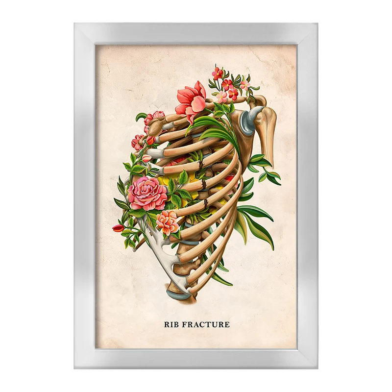 تابلو خندالو طرح شکستگی دنده (Rib Fracture) کد F13979