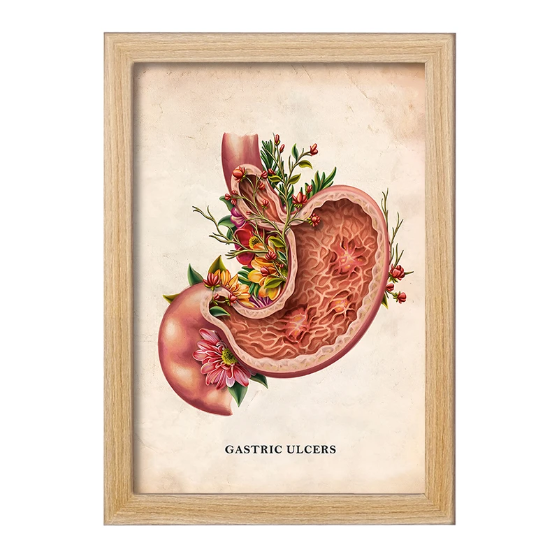 تابلو خندالو طرح بیماری زخم معده (Gastric Ulcers) کد F13978