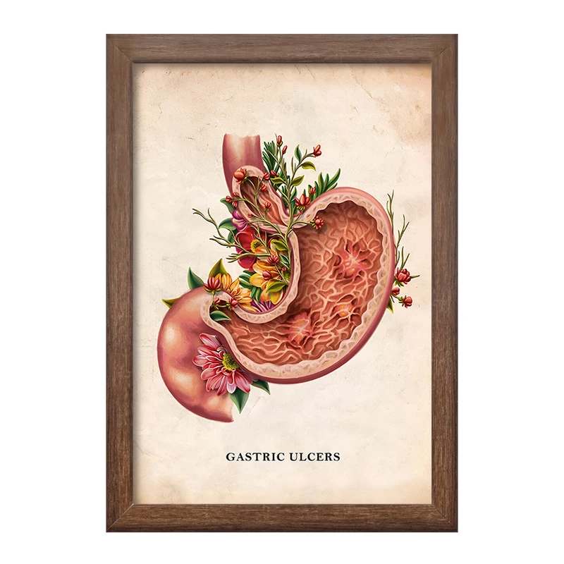 تابلو خندالو طرح بیماری زخم معده (Gastric Ulcers) کد F13978