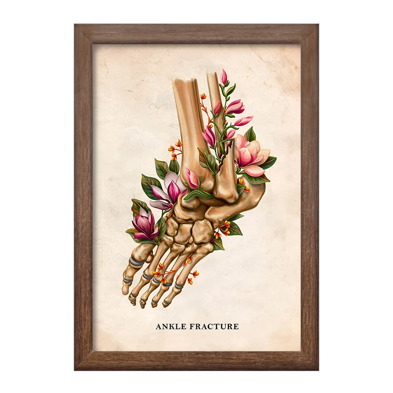 تابلو خندالو طرح شکستگی مچ پا (Ankle Fracture) کد F13981