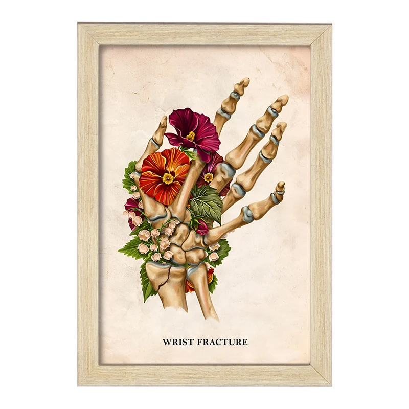 تابلو خندالو طرح شکستگی مچ دست (Wrist Fracture) کد F13988