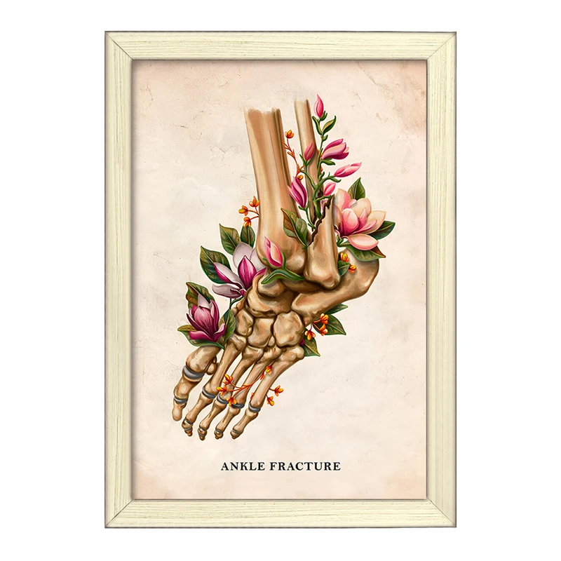 تابلو خندالو طرح شکستگی مچ پا (Ankle Fracture) کد F13981