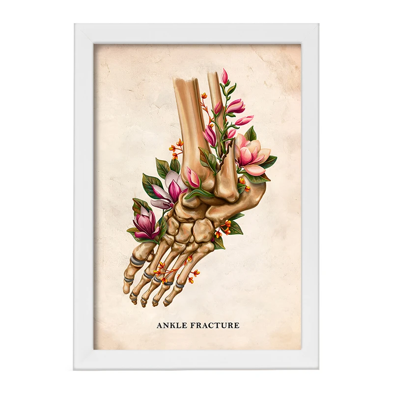 تابلو خندالو طرح شکستگی مچ پا (Ankle Fracture) کد F13981