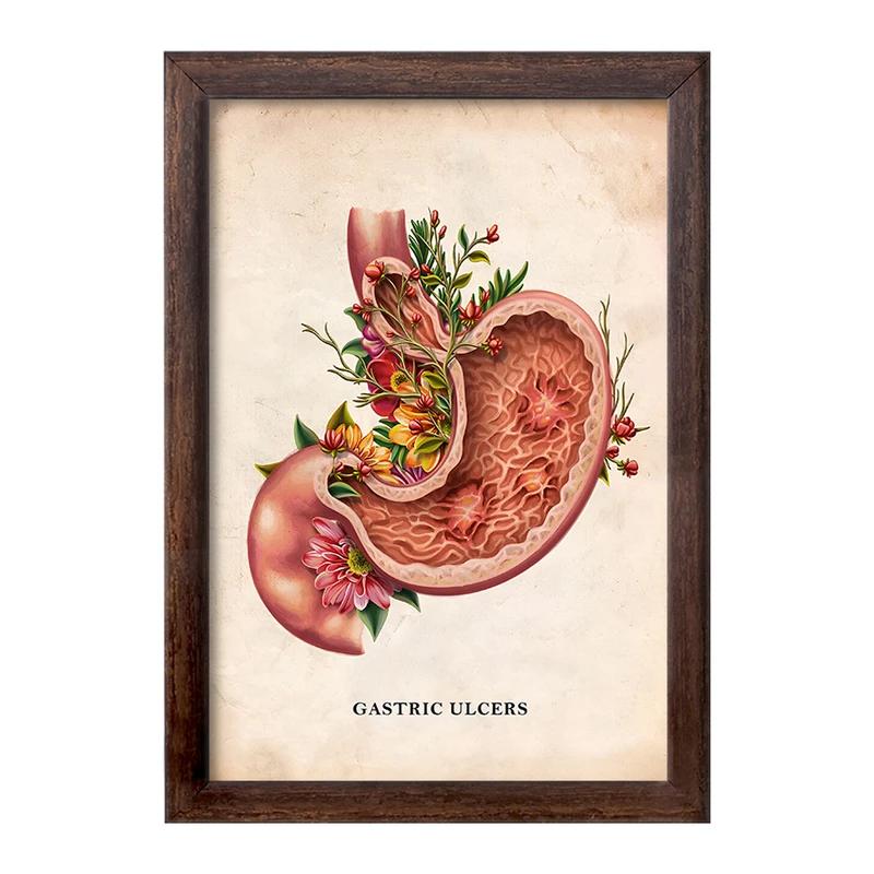 تابلو خندالو طرح بیماری زخم معده (Gastric Ulcers) کد F13978