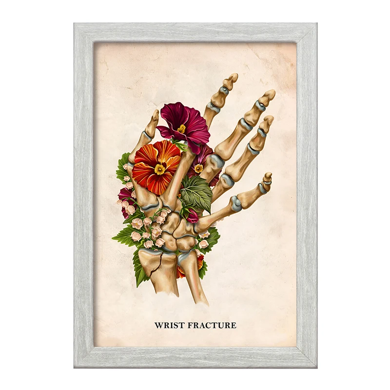 تابلو خندالو طرح شکستگی مچ دست (Wrist Fracture) کد F13988