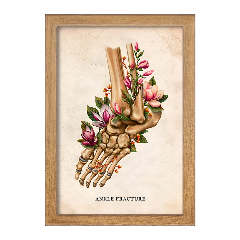 تابلو خندالو طرح شکستگی مچ پا (Ankle Fracture) کد F13981