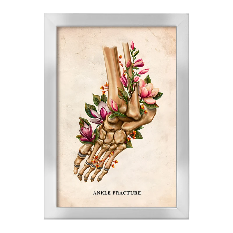 تابلو خندالو طرح شکستگی مچ پا (Ankle Fracture) کد F13981