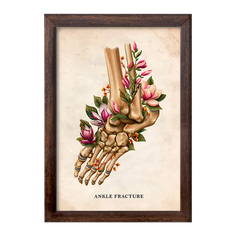 تابلو خندالو طرح شکستگی مچ پا (Ankle Fracture) کد F13981