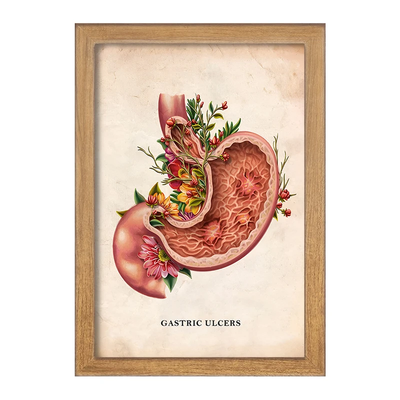 تابلو خندالو طرح بیماری زخم معده (Gastric Ulcers) کد F13978