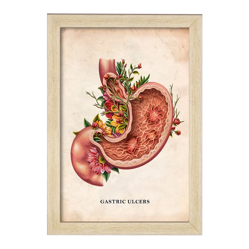 تابلو خندالو طرح بیماری زخم معده (Gastric Ulcers) کد F13978