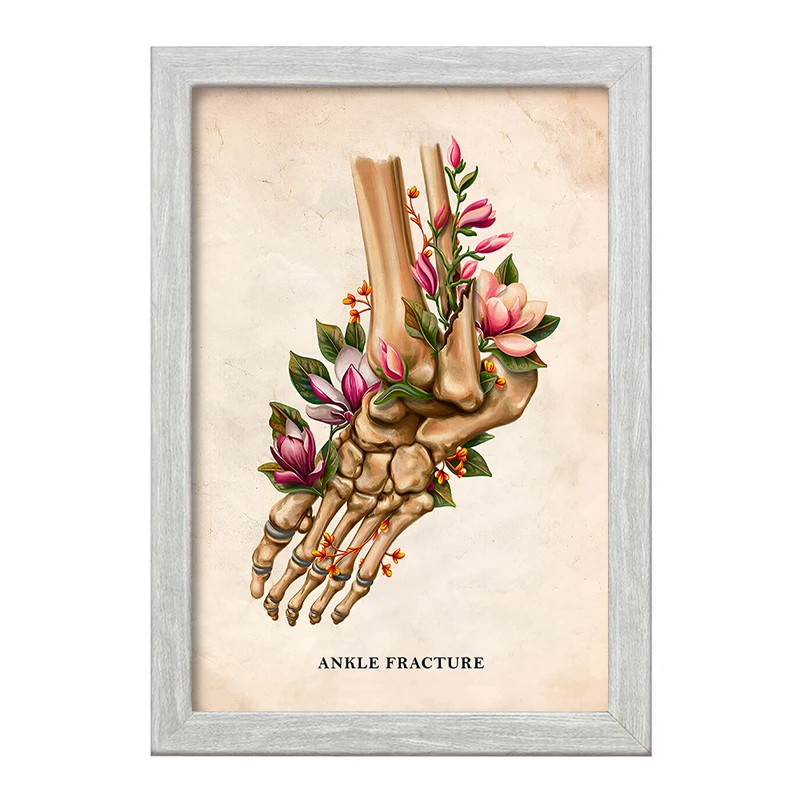 تابلو خندالو طرح شکستگی مچ پا (Ankle Fracture) کد F13981