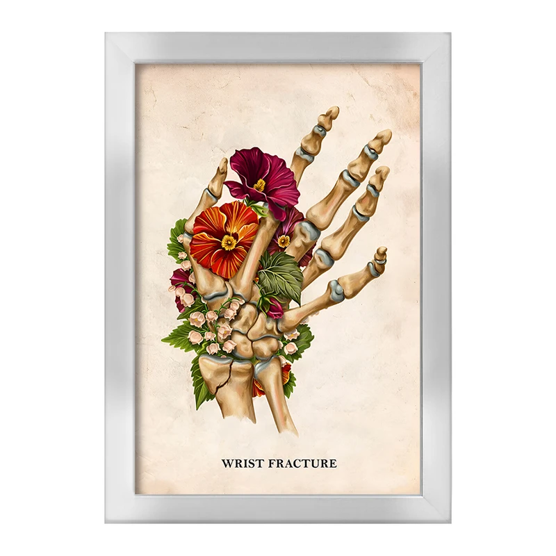 تابلو خندالو طرح شکستگی مچ دست (Wrist Fracture) کد F13988