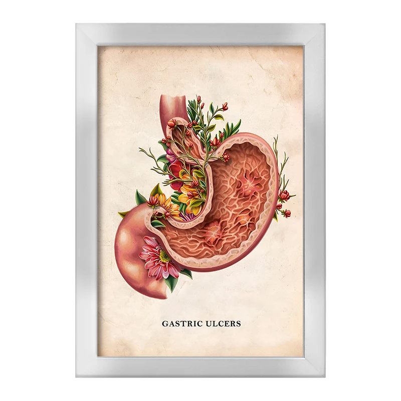 تابلو خندالو طرح بیماری زخم معده (Gastric Ulcers) کد F13978