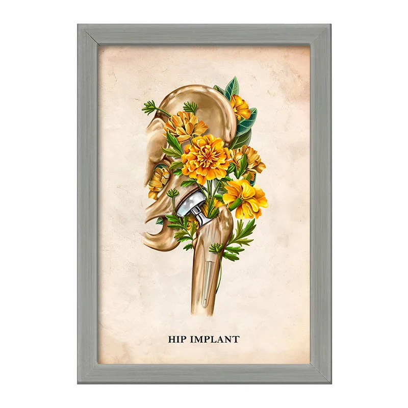تابلو خندالو طرح تعویض مفصل ران (Hip Replacement) کد F13991