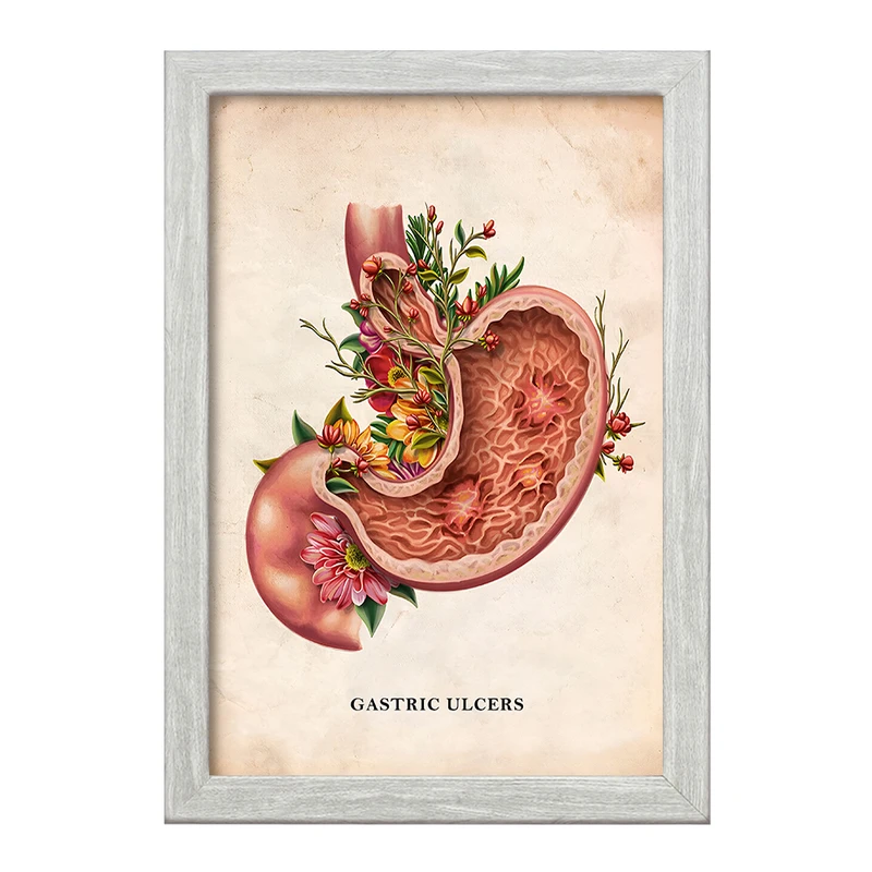 تابلو خندالو طرح بیماری زخم معده (Gastric Ulcers) کد F13978