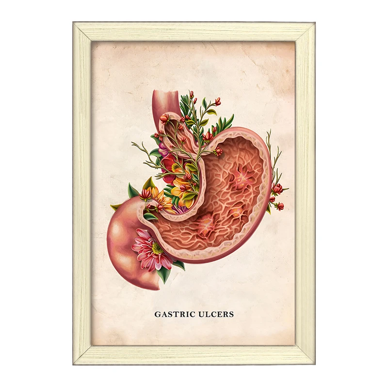 تابلو خندالو طرح بیماری زخم معده (Gastric Ulcers) کد F13978