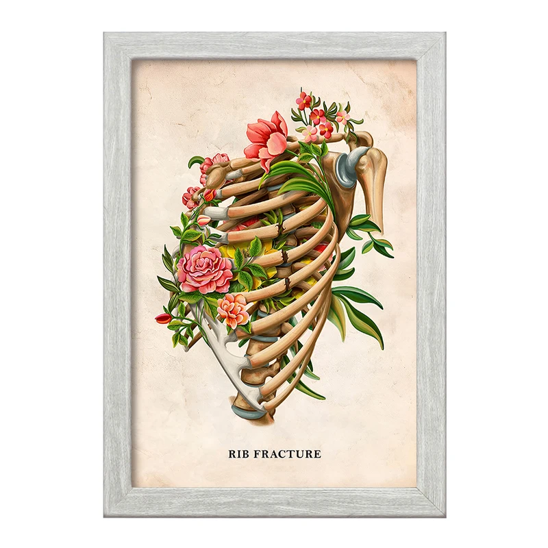تابلو خندالو طرح شکستگی دنده (Rib Fracture) کد F13979