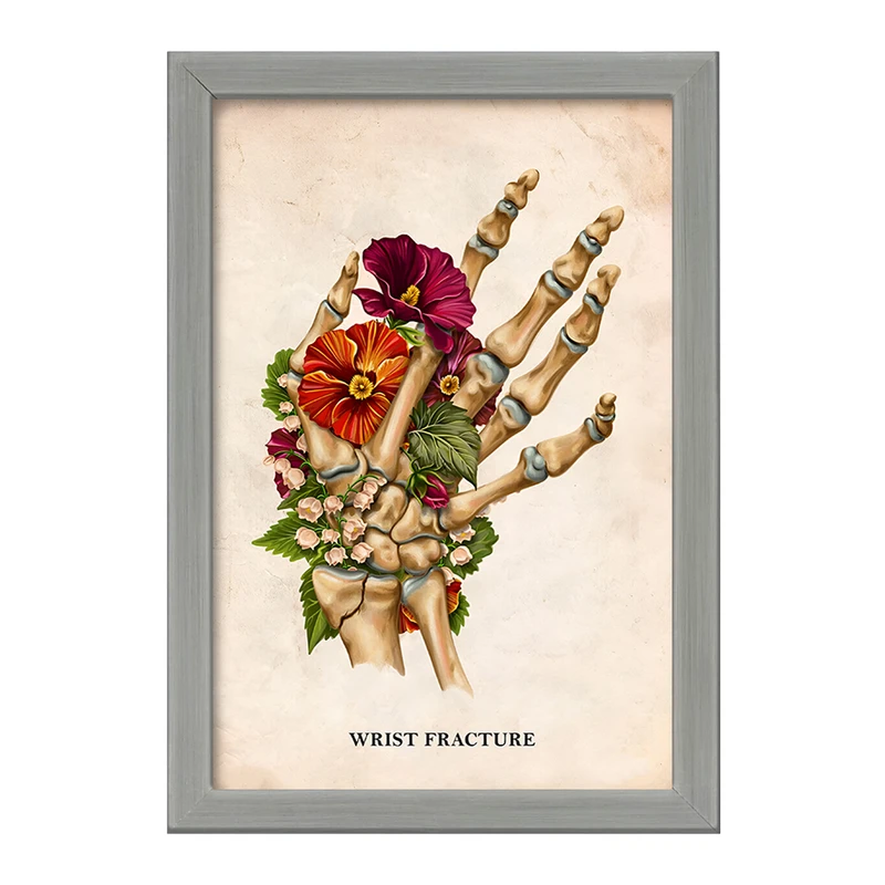 تابلو خندالو طرح شکستگی مچ دست (Wrist Fracture) کد F13988