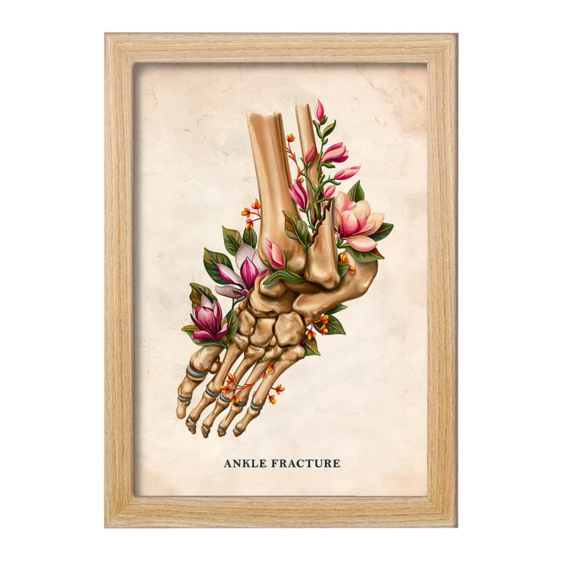 تابلو خندالو طرح شکستگی مچ پا (Ankle Fracture) کد F13981