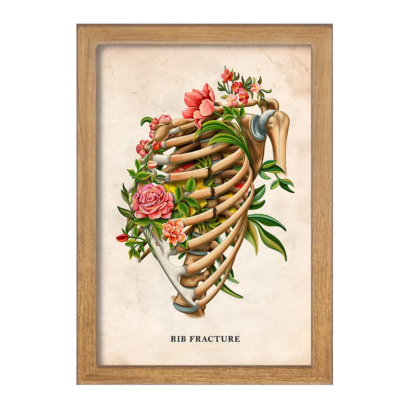 تابلو خندالو طرح شکستگی دنده (Rib Fracture) کد F13979