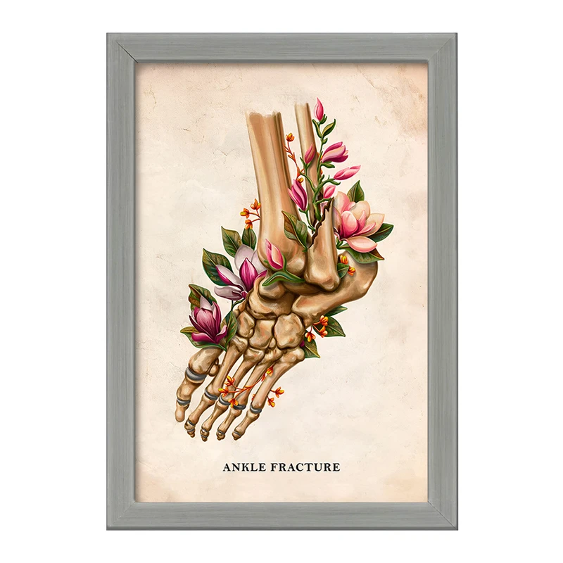 تابلو خندالو طرح شکستگی مچ پا (Ankle Fracture) کد F13981