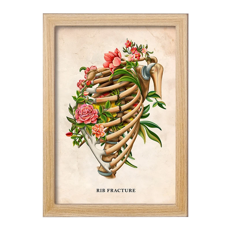 تابلو خندالو طرح شکستگی دنده (Rib Fracture) کد F13979
