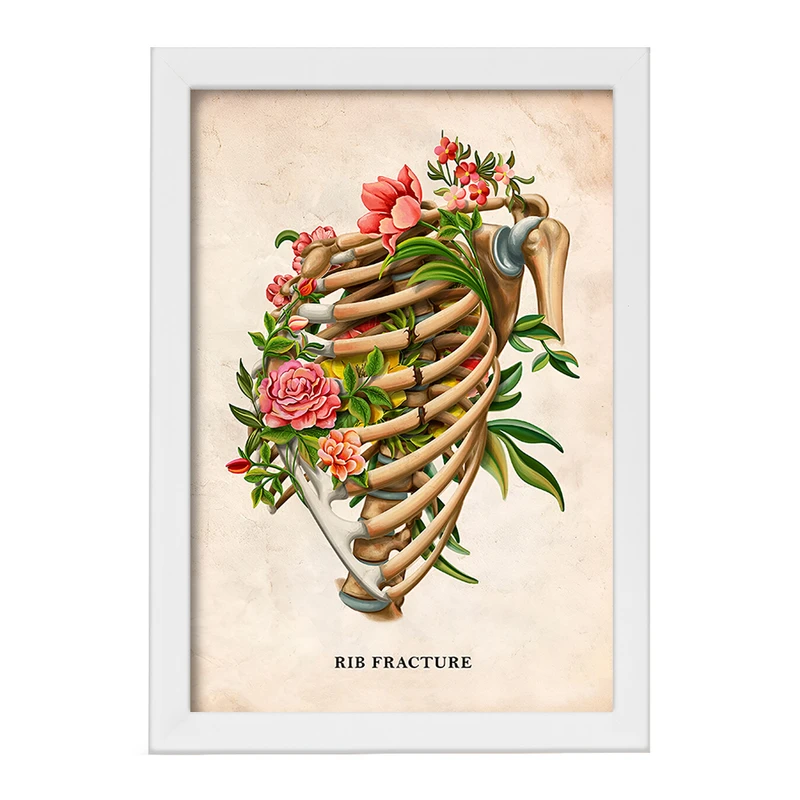 تابلو خندالو طرح شکستگی دنده (Rib Fracture) کد F13979
