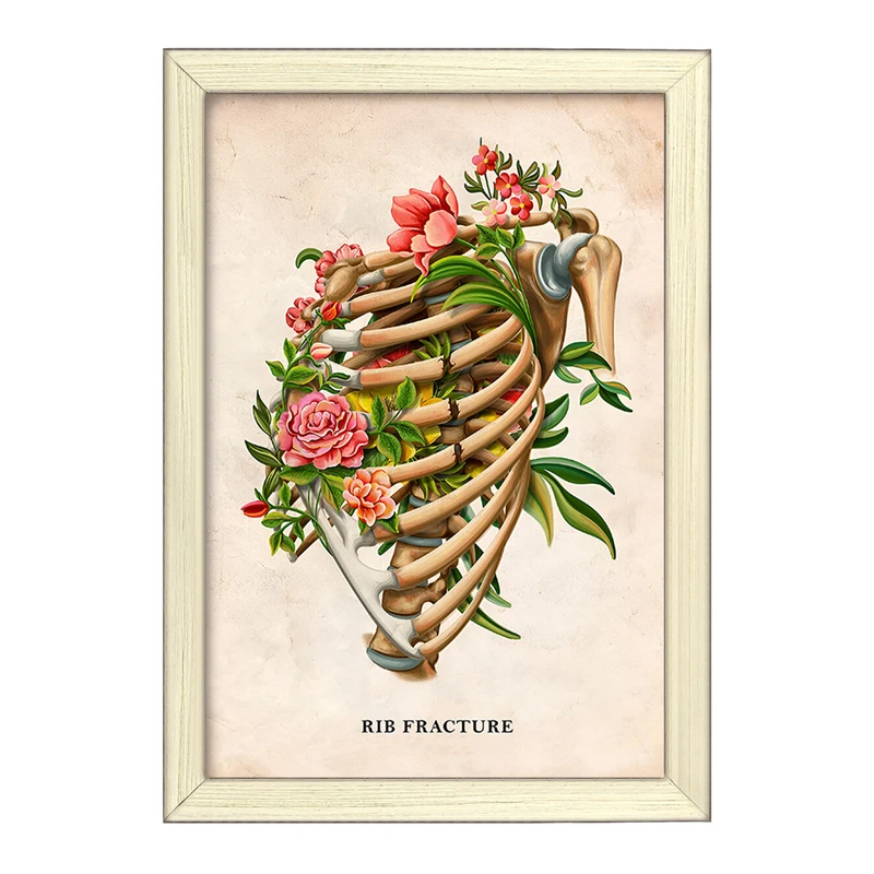 تابلو خندالو طرح شکستگی دنده (Rib Fracture) کد F13979