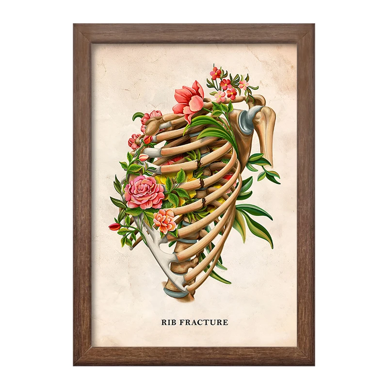 تابلو خندالو طرح شکستگی دنده (Rib Fracture) کد F13979
