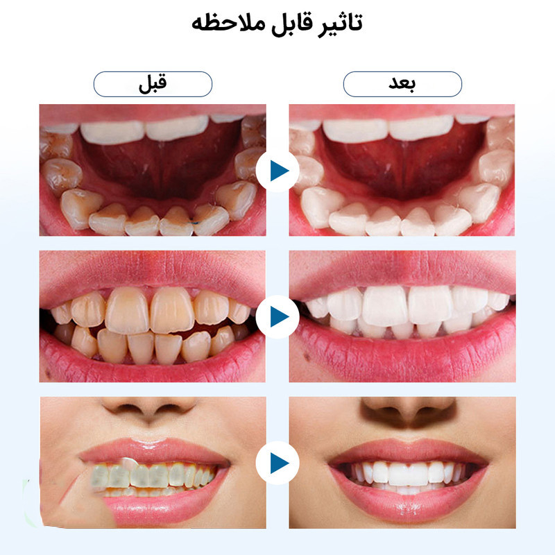 دستگاه شست و شو و جرم گیر دندان برقی مدل IPX7