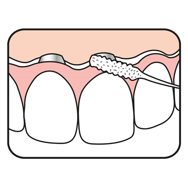 نخ دندان ته‏ په مدل Bridge and Implant Floss بسته 30 عددی