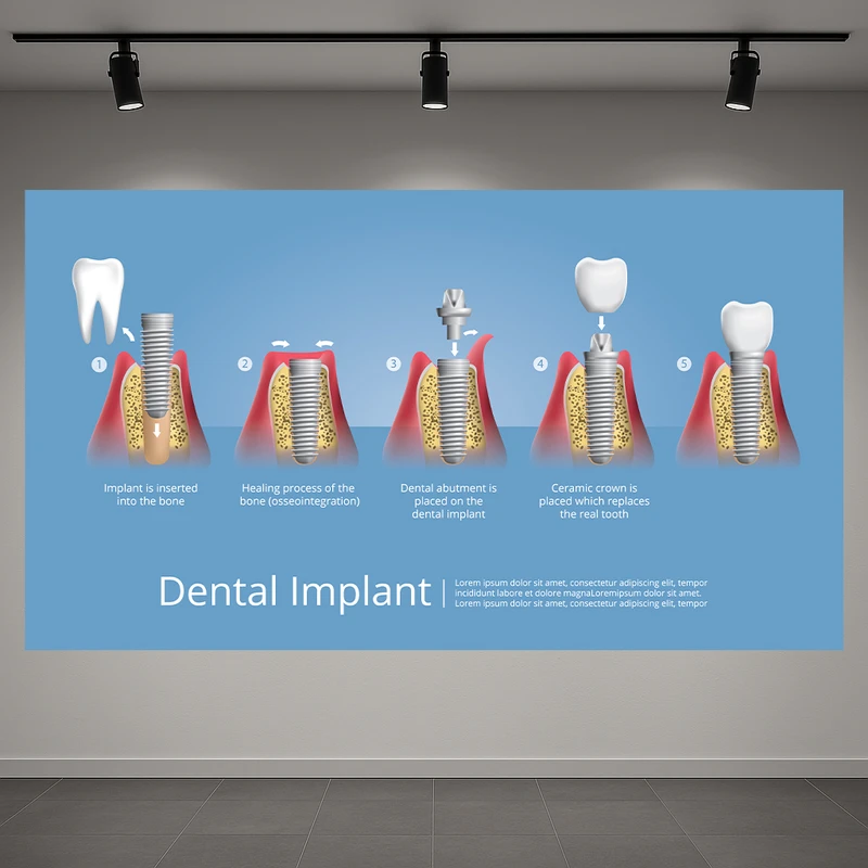 تابلو بوم طرح مخمل ایمپلنت مدل دندان های انسان کد AR3060082