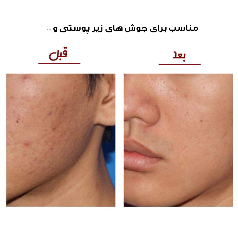 میکرودرم خانگی مدل SCRW-5 میکرودرم خانگی مدل SCRW-5