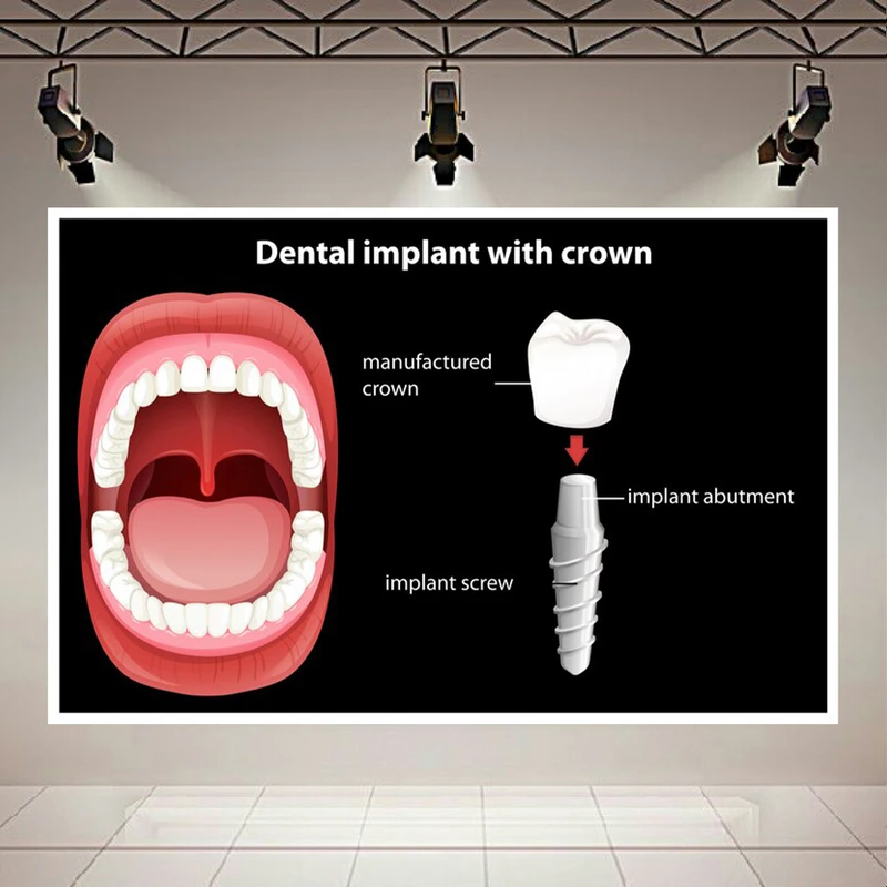 تابلو بوم طرح مخمل پزشکی مدل ایمپلنت دندان کد AR305518