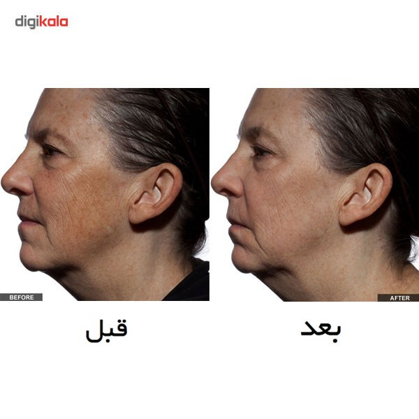 لیزر جوان سازی تریا مدل Age Defying